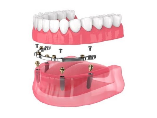 What Is the Bar Attachment Denture Dental Implant Technique?